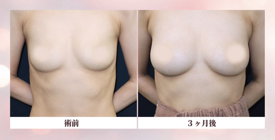 【デザイン性抜群🎖️】<br />
どこから見ても自然で丸みのあるバストに