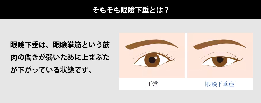 そもそも眼瞼下垂とは？