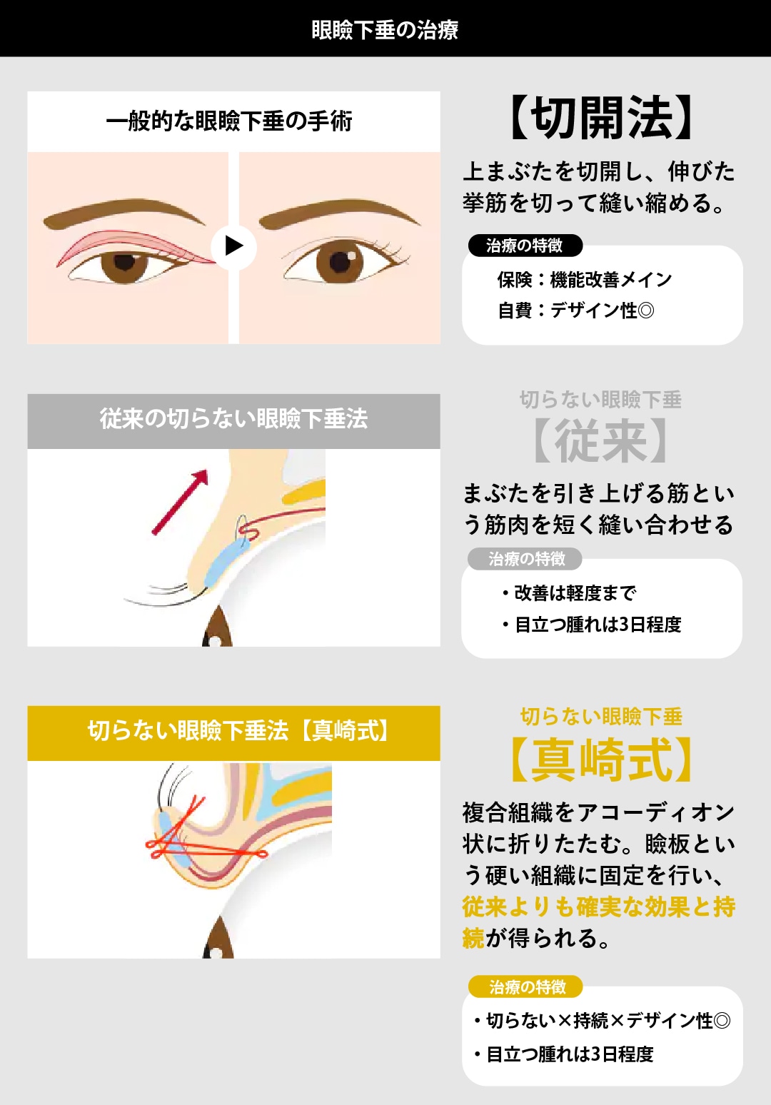 眼瞼下垂の治療