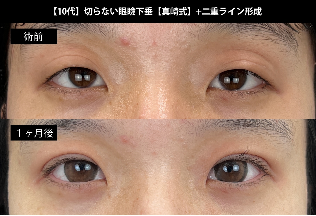 切らない眼瞼下垂真崎式+二重ライン形成