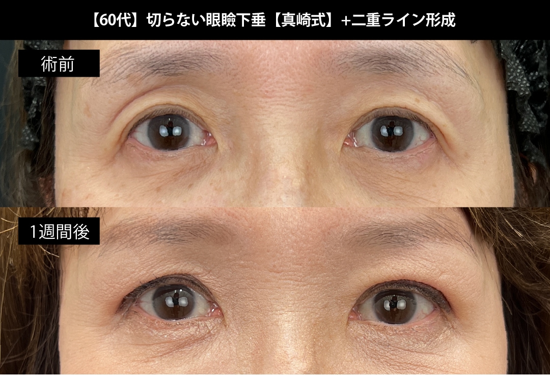 切らない眼瞼下垂真崎式+二重ライン形成