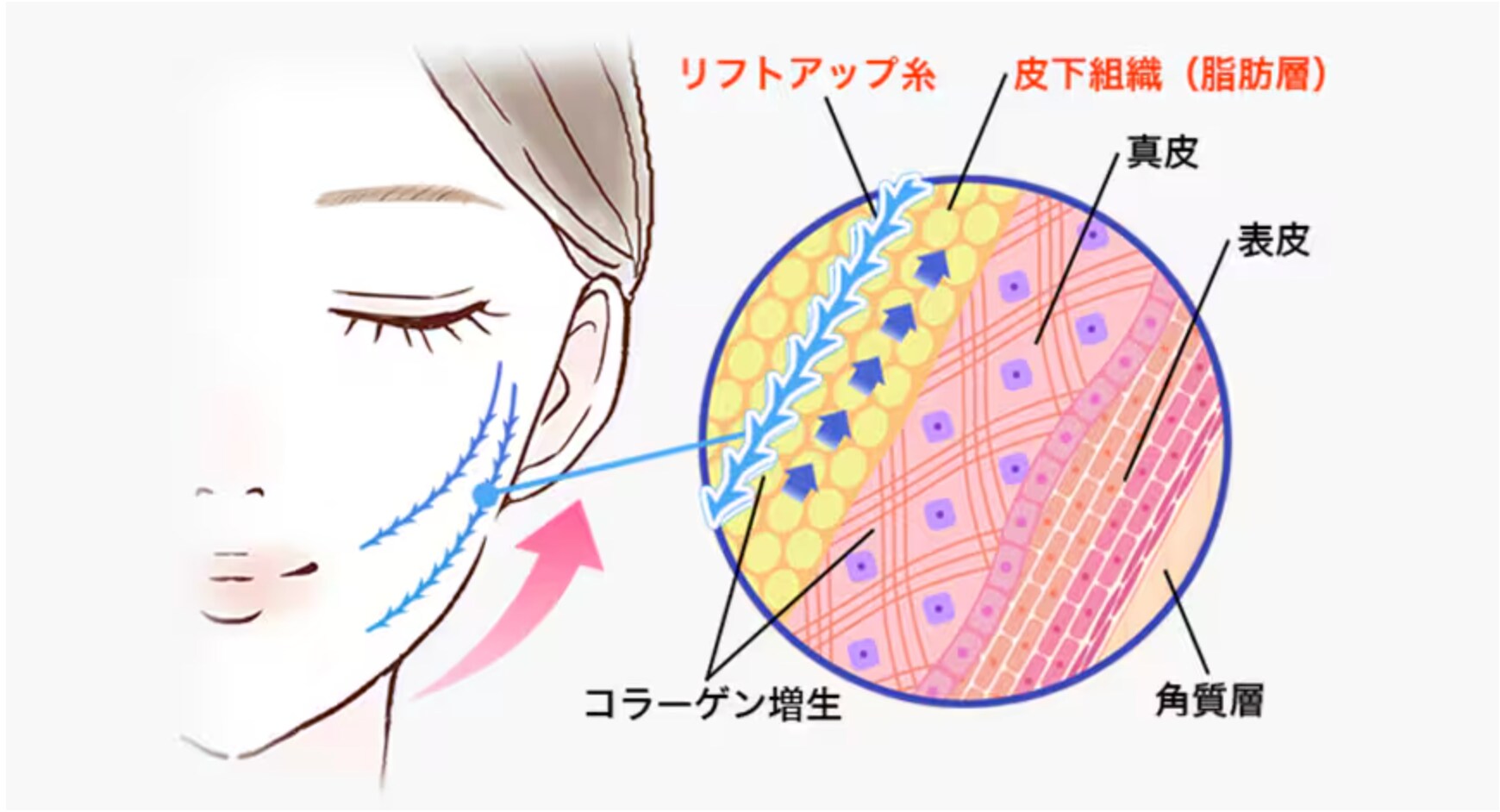 切らずにできるお手軽な小顔術！！