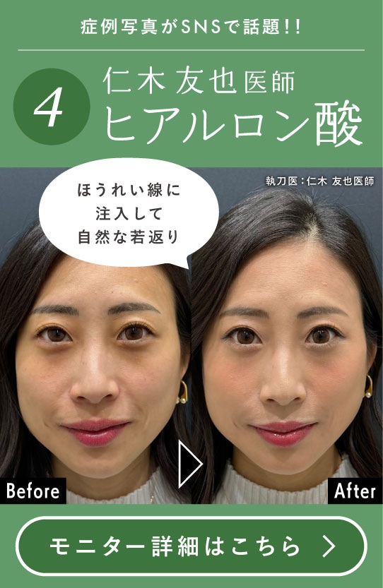 【ヒアルロン酸】仁木先生のヒアルロン酸で手軽に若返り！