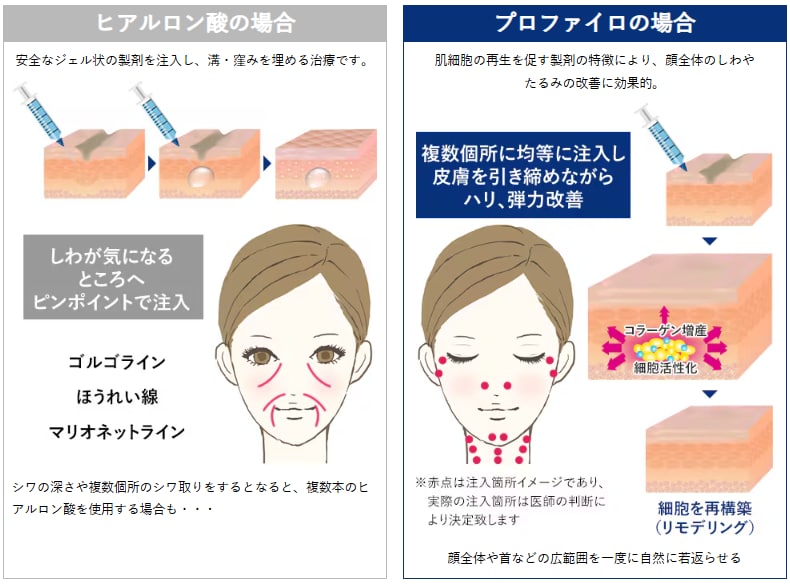 プロファイロ