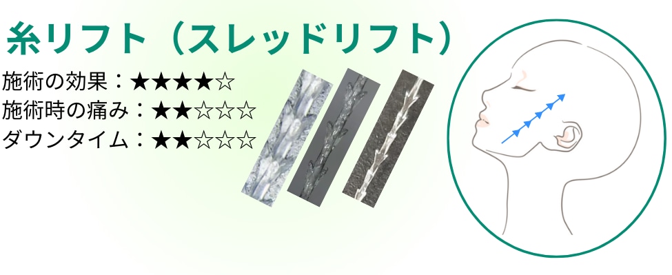 糸リフト