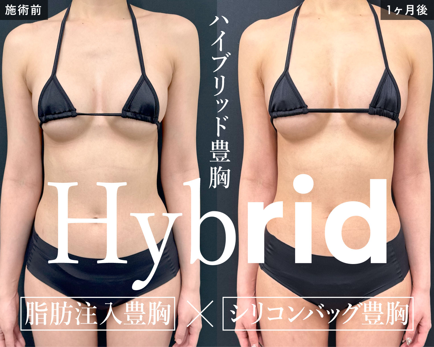 【脂肪注入豊胸✖️シリコンバッグ豊胸】ハイブリッド豊胸 で理想のバストに！