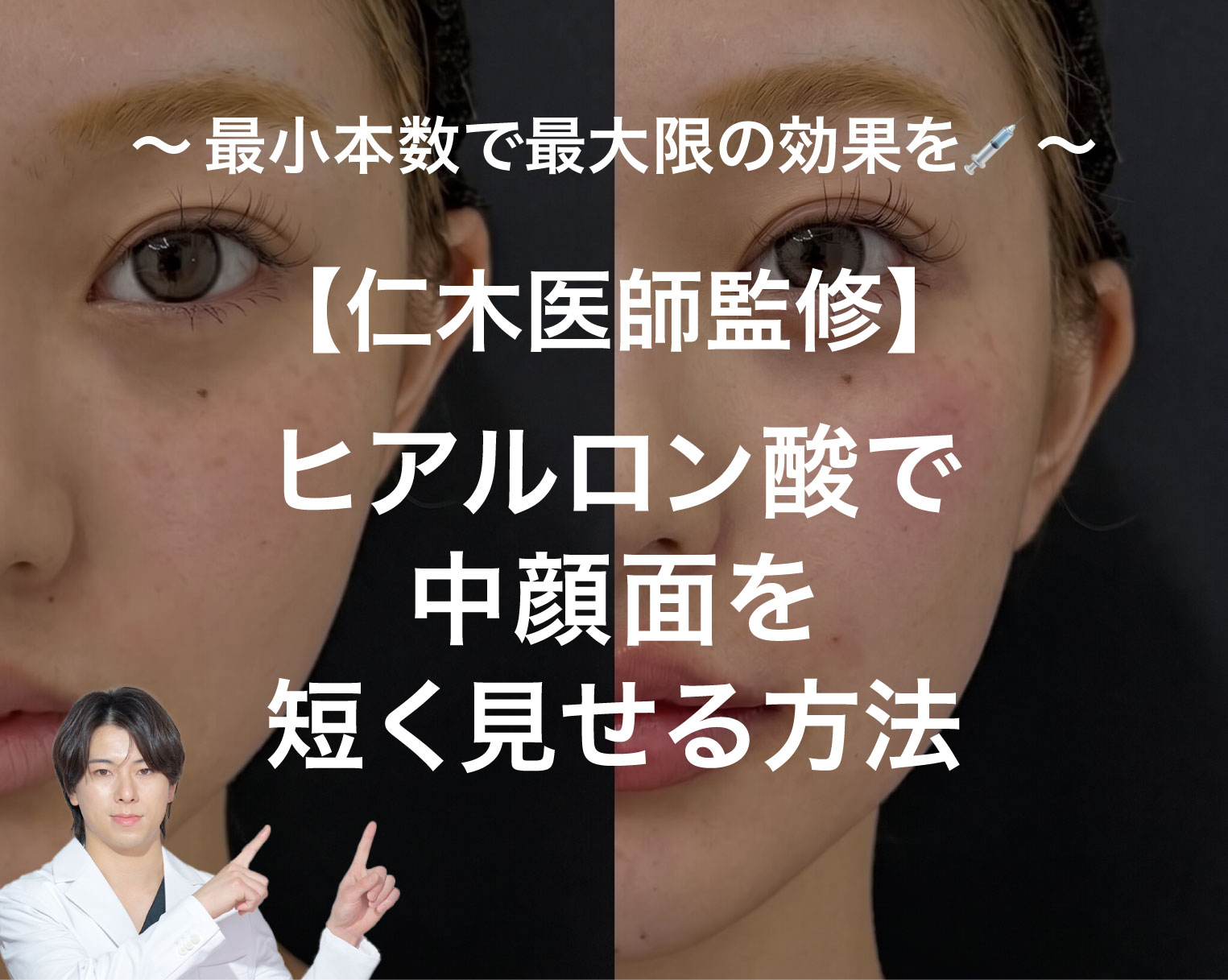 【ヒアルロン酸おすすめドクター仁木医師監修】 ヒアルロン酸で中顔面を短く見せる方法