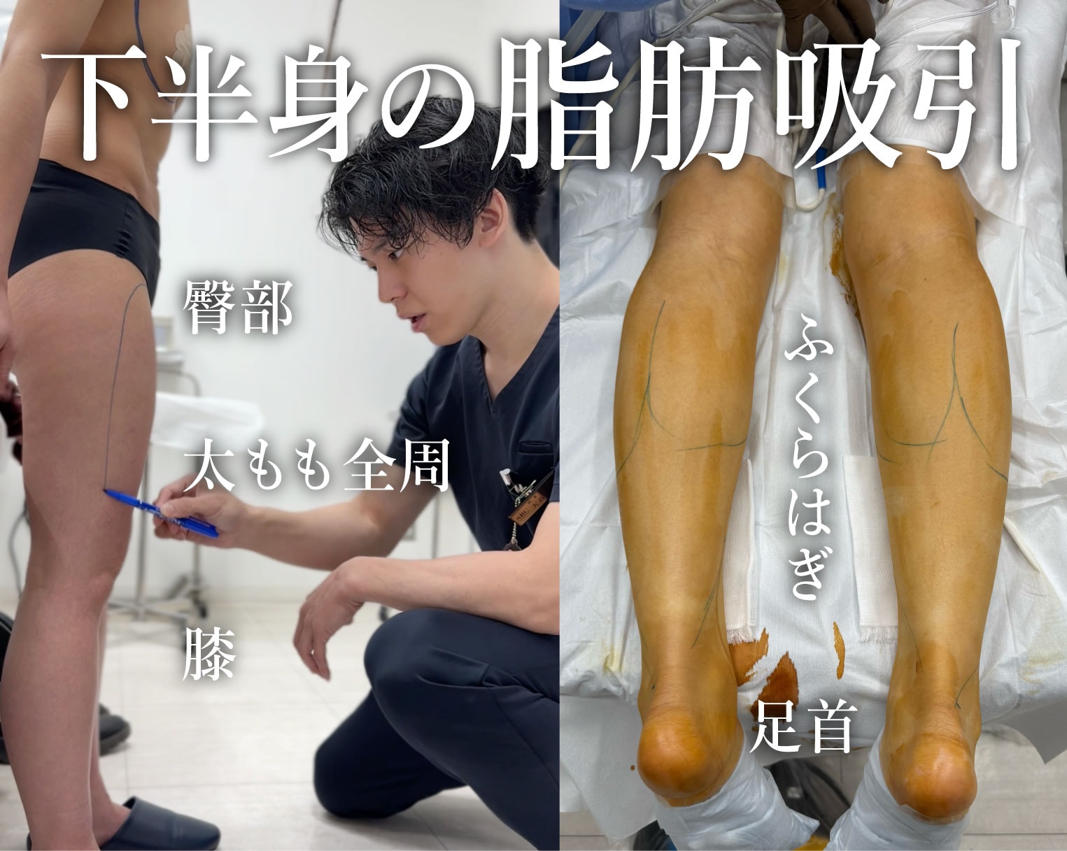 痩せづらい下半身はまとめてすっきり！太もも・ふくらはぎ・足首の脂肪吸引
