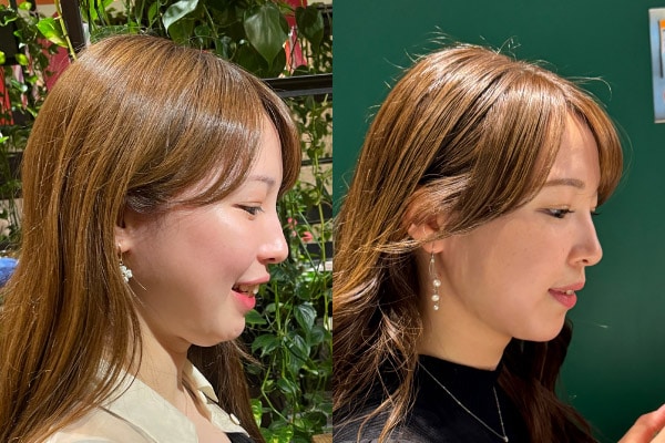 糸リフトはいらない？脂肪吸引の名医が徹底解説