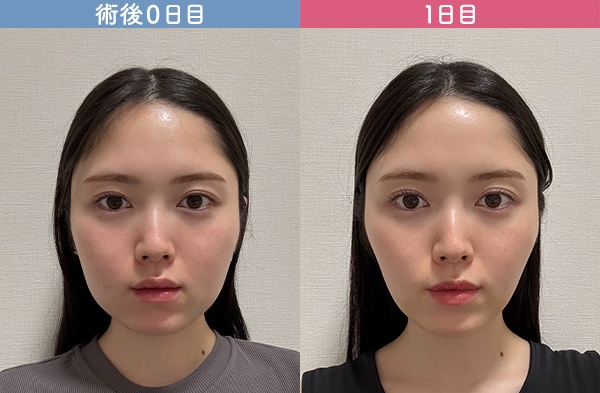術後１日目