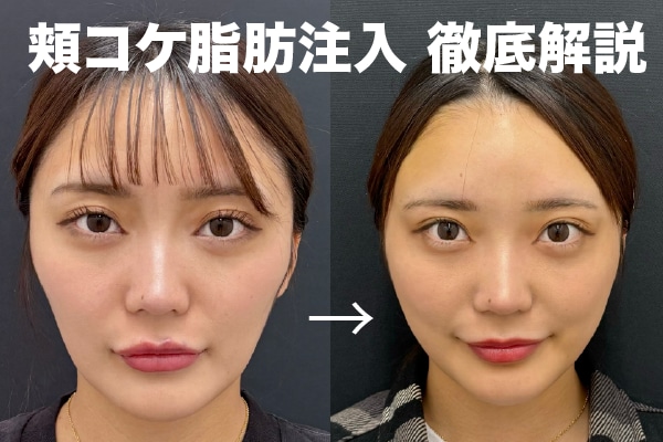 【頬コケ脂肪注入で若返る】脂肪吸引の名医が徹底解説！実際のダウンタイムも紹介します