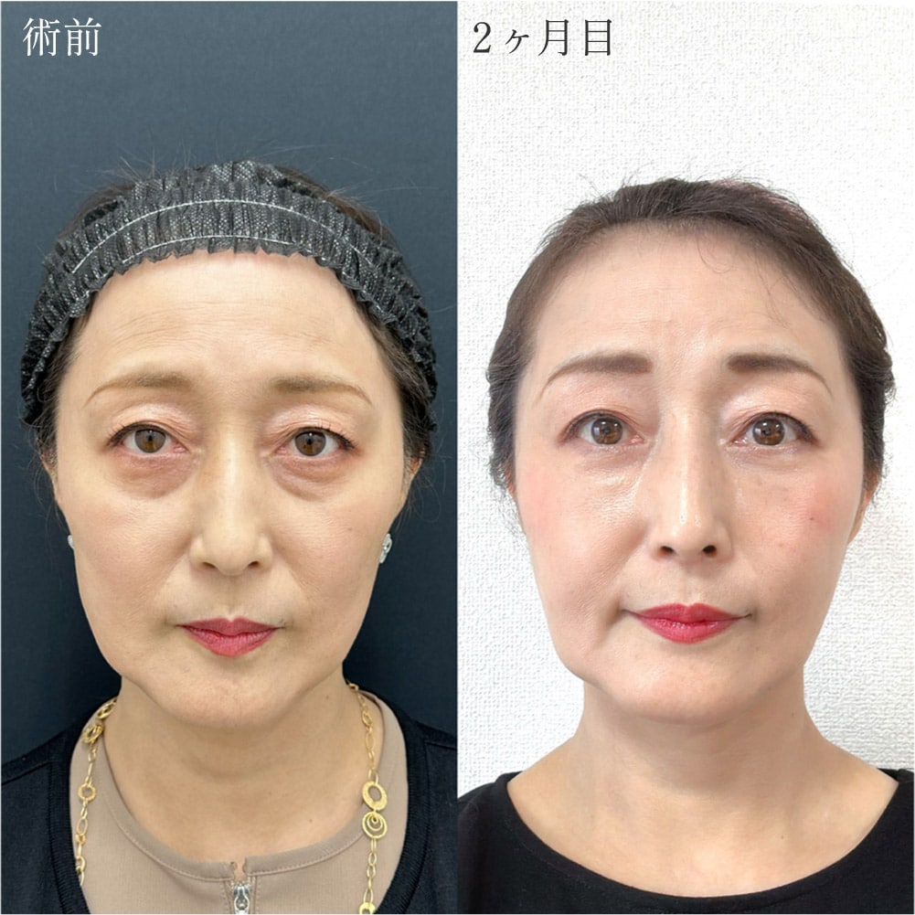 51歳　脱脂＋脂肪注入(目の下〜ゴルゴ線)