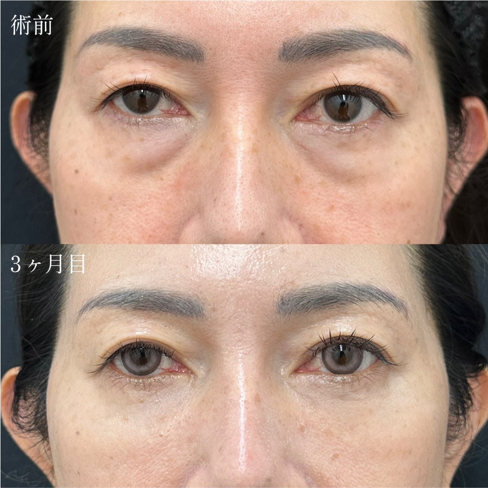 56歳　裏ハムラ