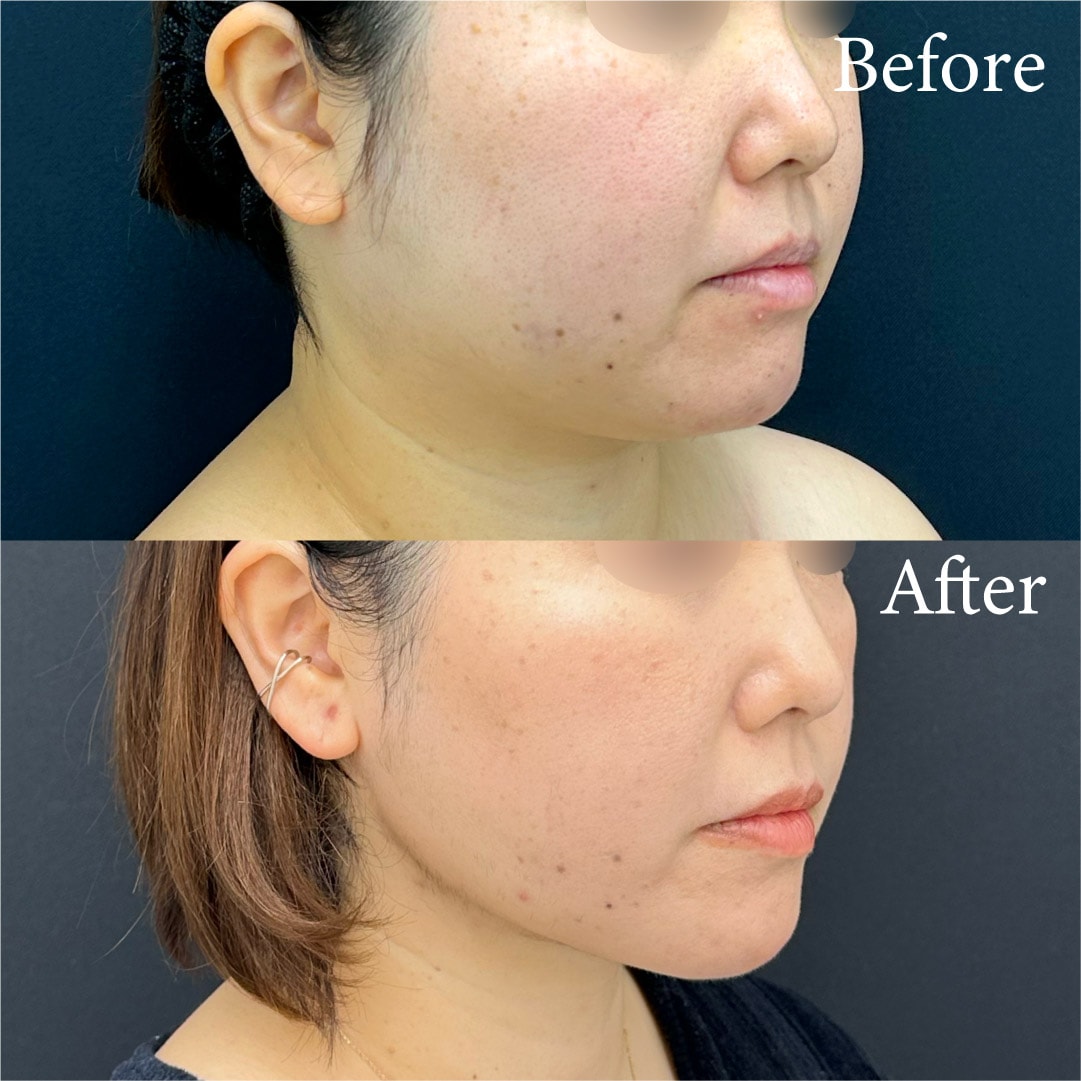 30代・脂肪吸引×糸でたるみ知らずに