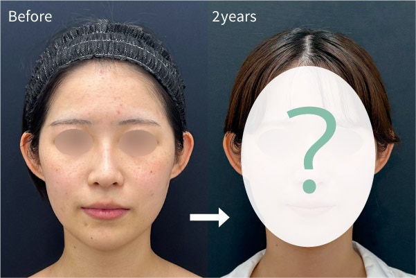 【長期経過】脂肪吸引注射は効果ないって本当？脂肪吸引注射の名医が2年経過の症例を解説