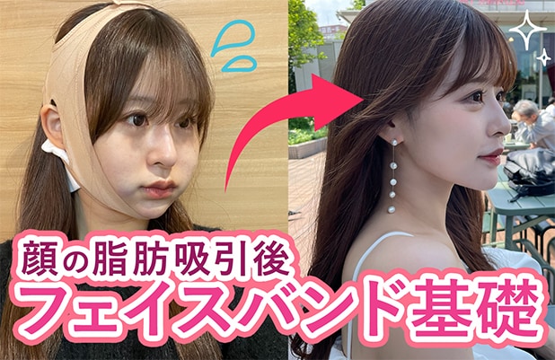 【顔の脂肪吸引】フェイスバンドしないとどうなる？効果・着用期間・注意点まとめ