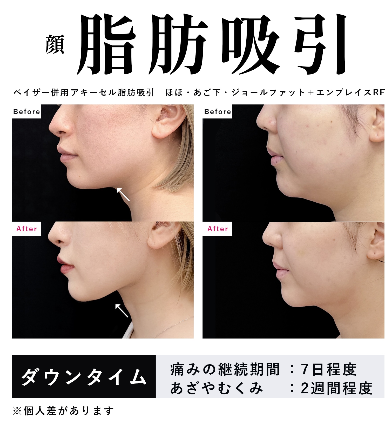 ベイザー併用アキーセル脂肪吸引