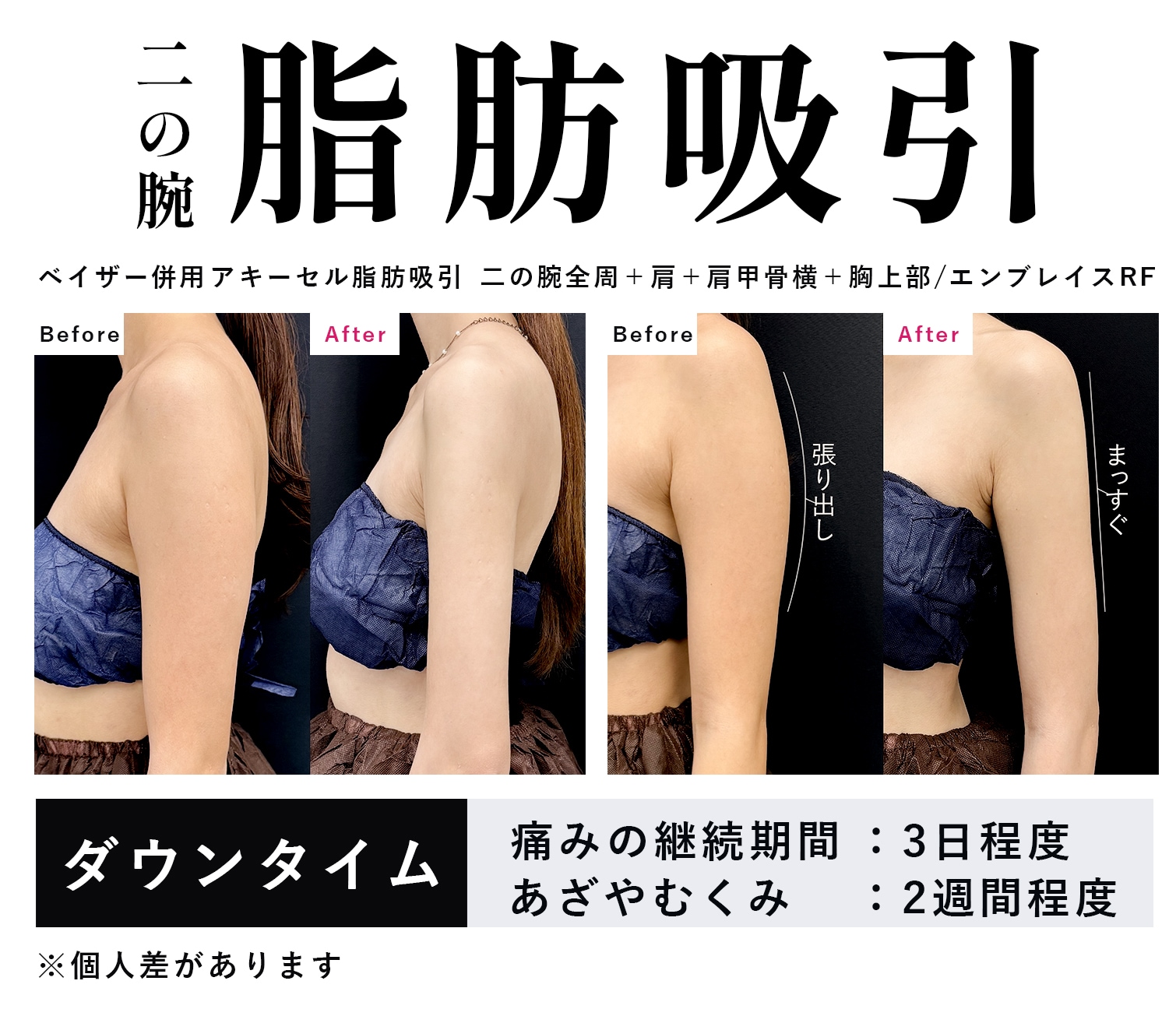 ベイザー併用アキーセル脂肪吸引