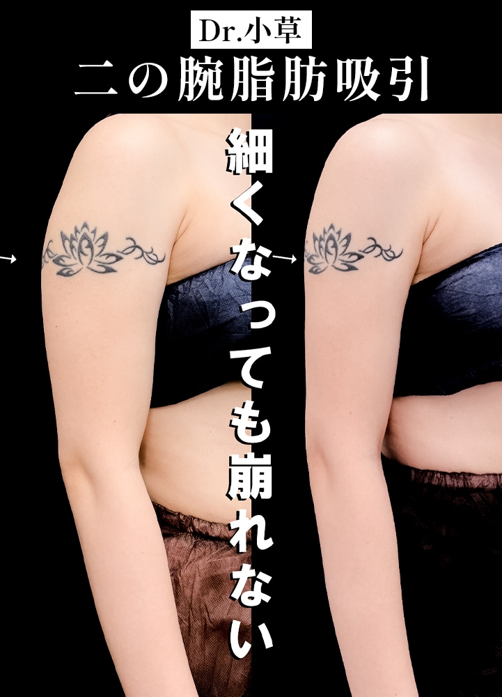 【二の腕脂肪吸引の名医】タトゥーがあっても脂肪吸引できます。崩れないデザインで人気【二の腕脂肪吸引が上手いおぐさ先生】