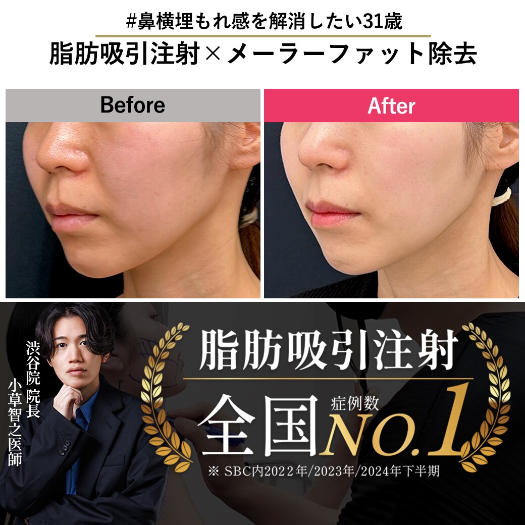 【脂肪吸引注射の名医】”中顔面もたつき解消したい”31歳女性