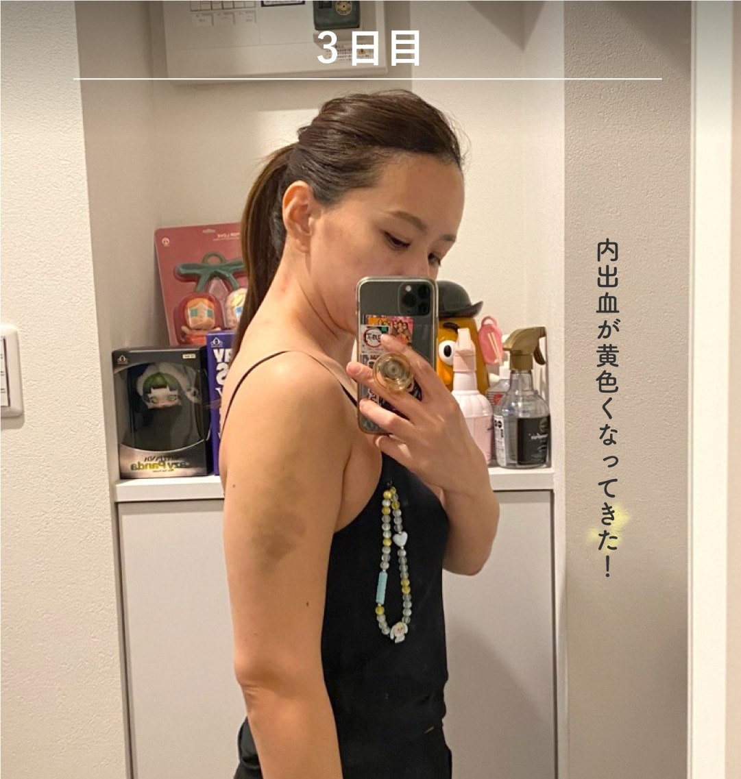 術後3日目