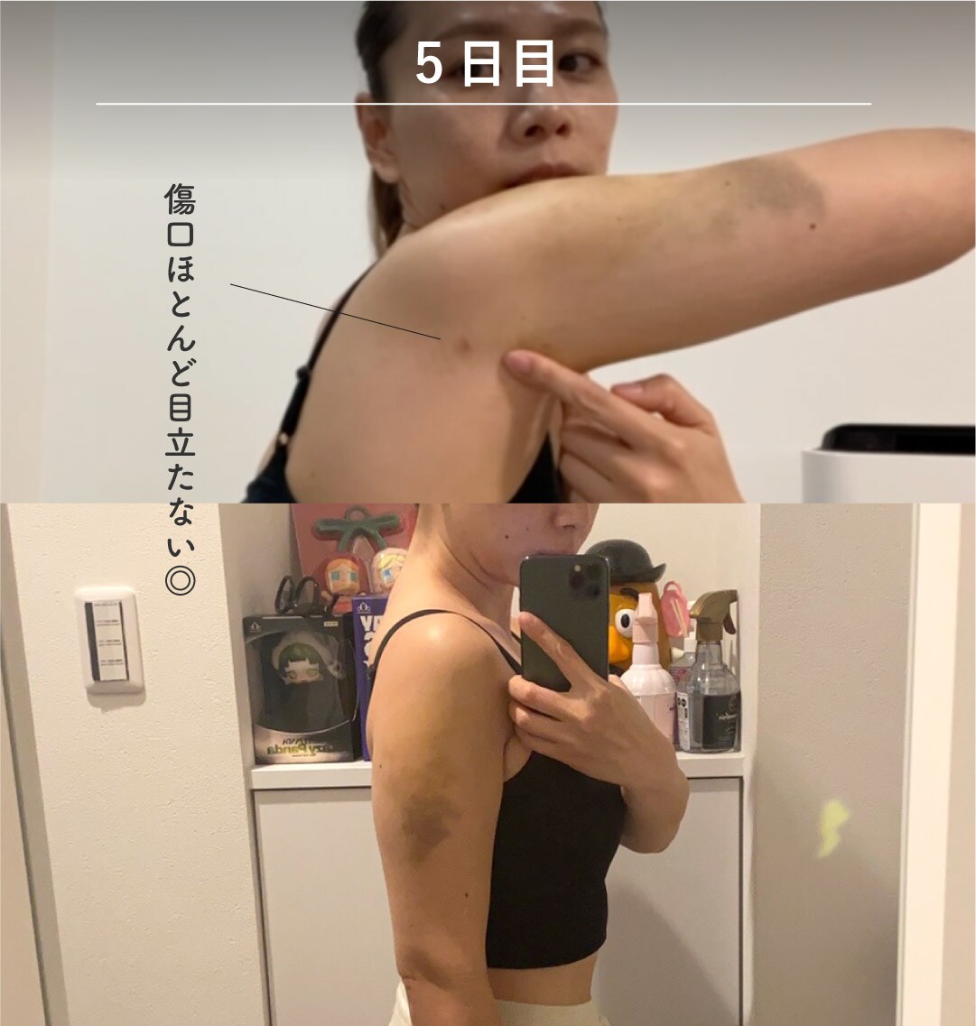 術後5日目