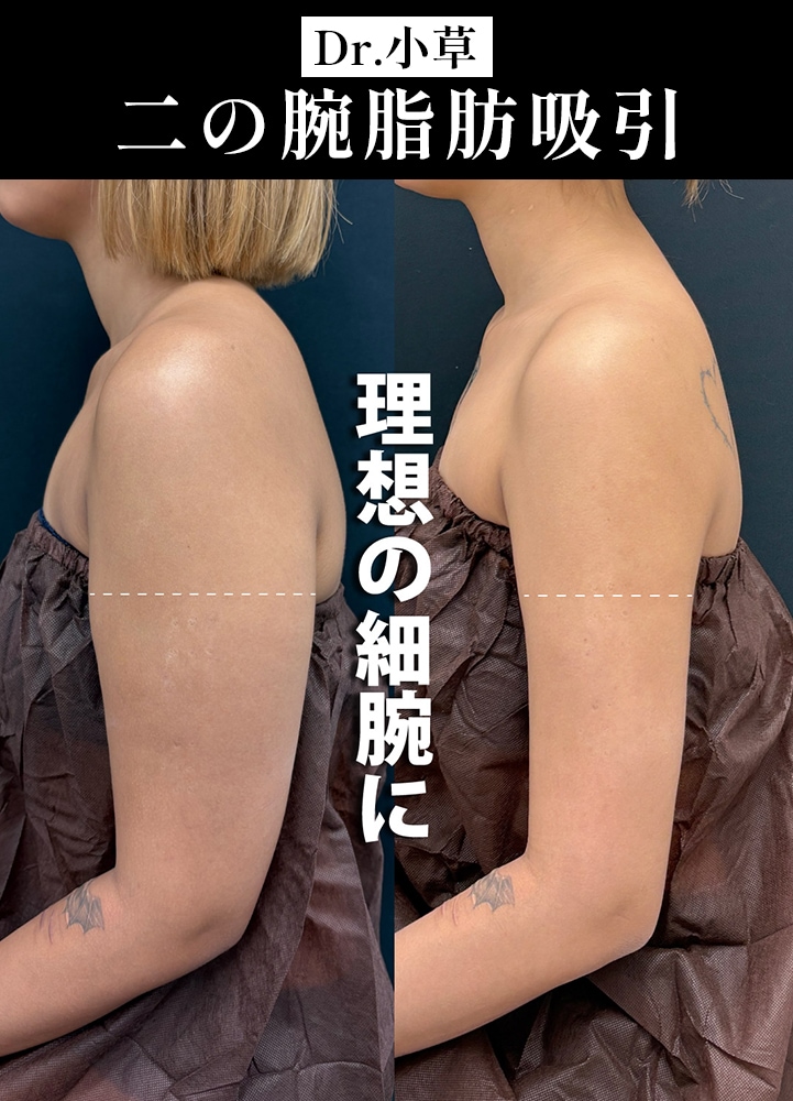 【二の腕脂肪吸引の名医】どんな服でも映える細腕に【二の腕脂肪吸引が上手いおぐさ先生】