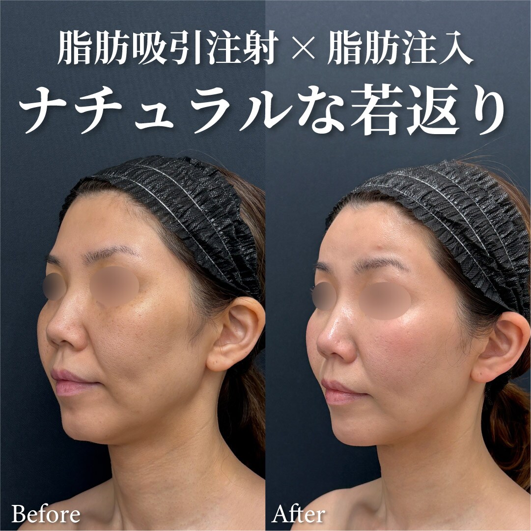44歳女性のモニター様