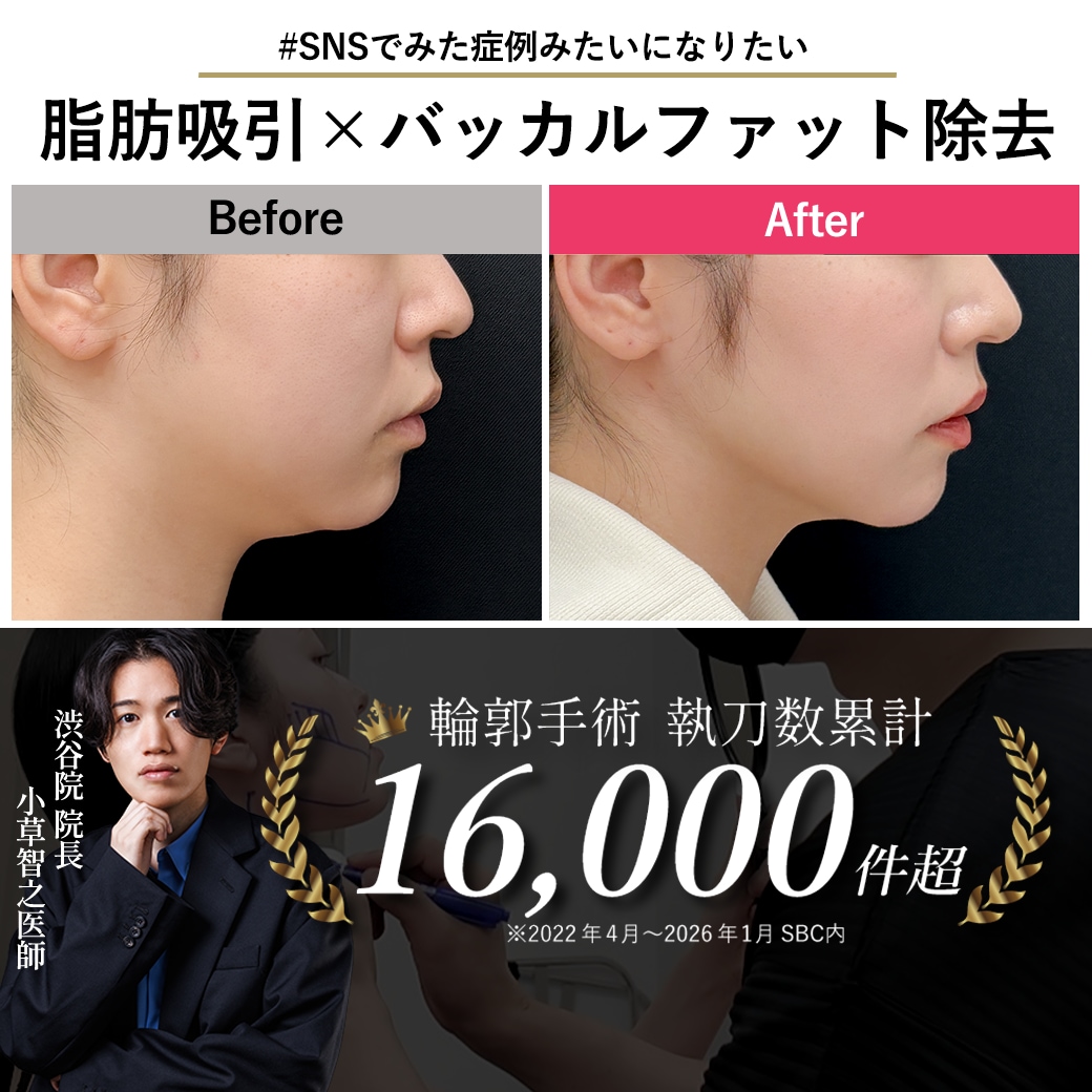 【顔の脂肪吸引の名医】バッカルファット除去で劇的小顔！24歳が選んだ「おぐさ先生」【脂肪吸引が上手いおぐさ先生】