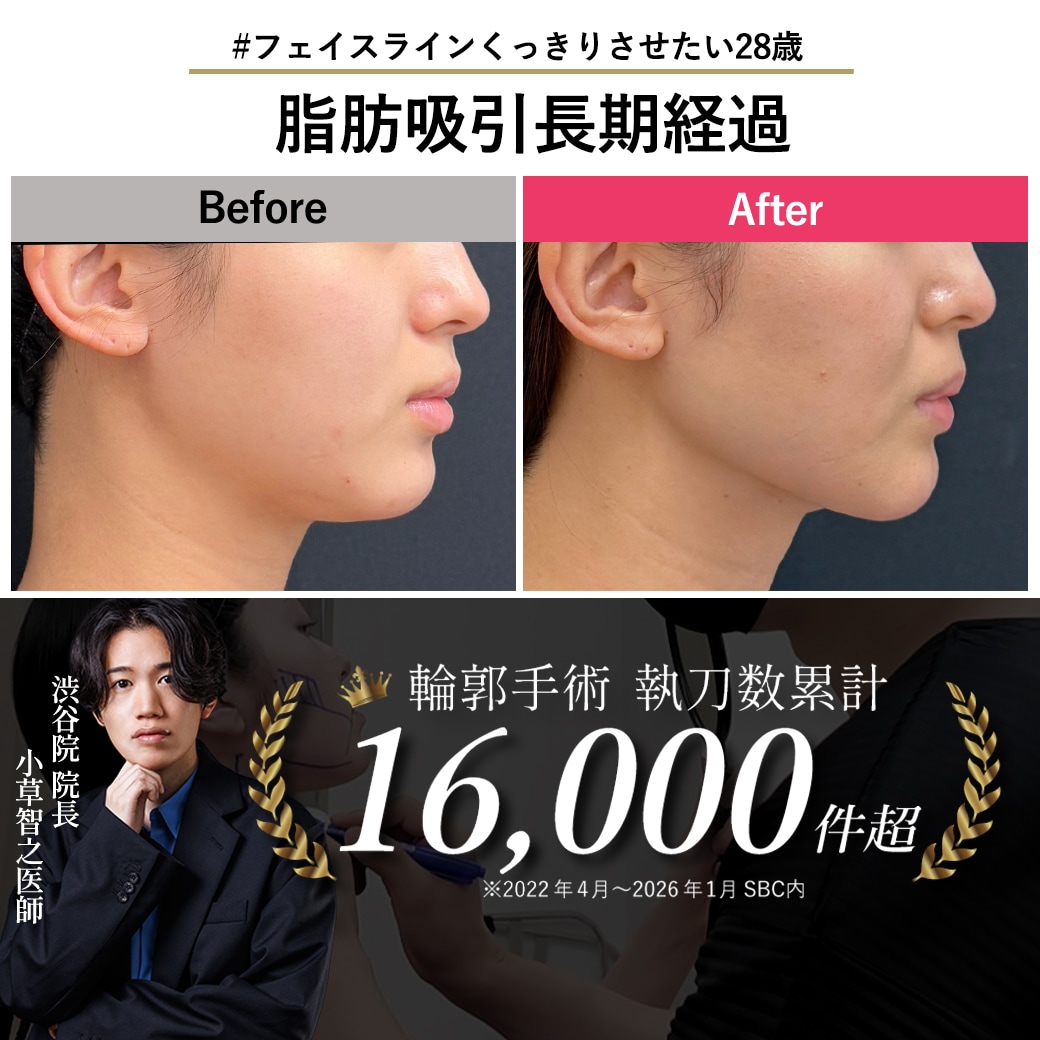 【脂肪吸引の名医】貴重!脂肪吸引400日後の経過見せます【脂肪吸引が上手い小草先生】