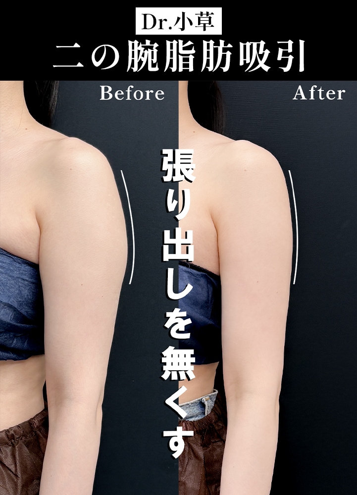 【二の腕脂肪吸引の名医】肩甲骨までスッキリ！「術直後から変化を実感」褒められ細腕デザイン