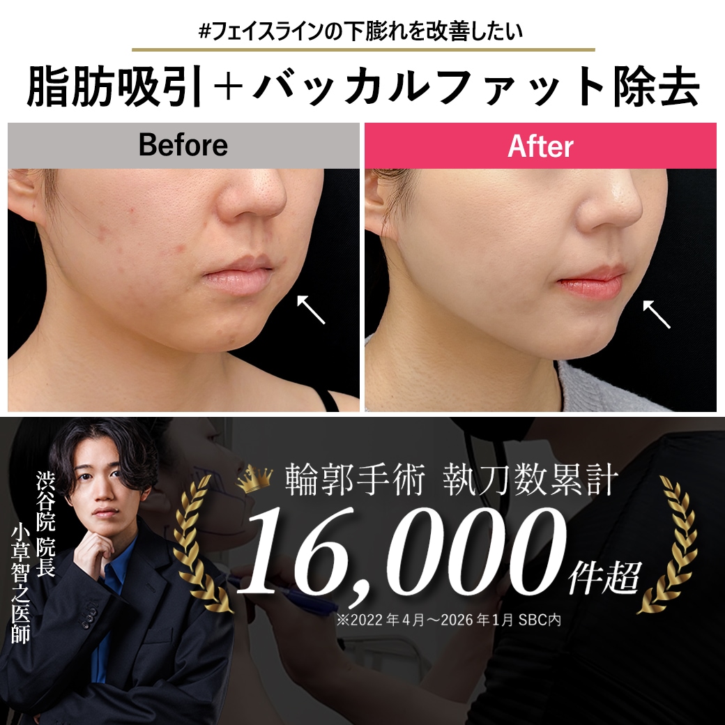 【顔脂肪吸引の名医】バッカルファット除去で変わる下膨れ改善！【脂肪吸引が上手いおぐさ先生】