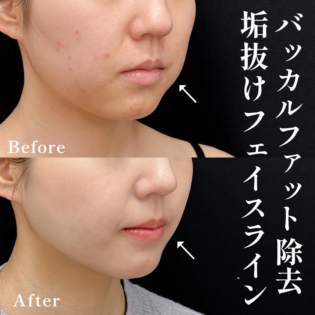 20代女性のモニター様
