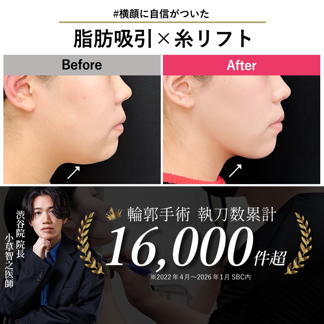 【顔脂肪吸引の名医】横顔コンプレックスを克服!20代で「二重アゴ卒業」して理想のEラインに【脂肪吸引が上手いおぐさ先生】
