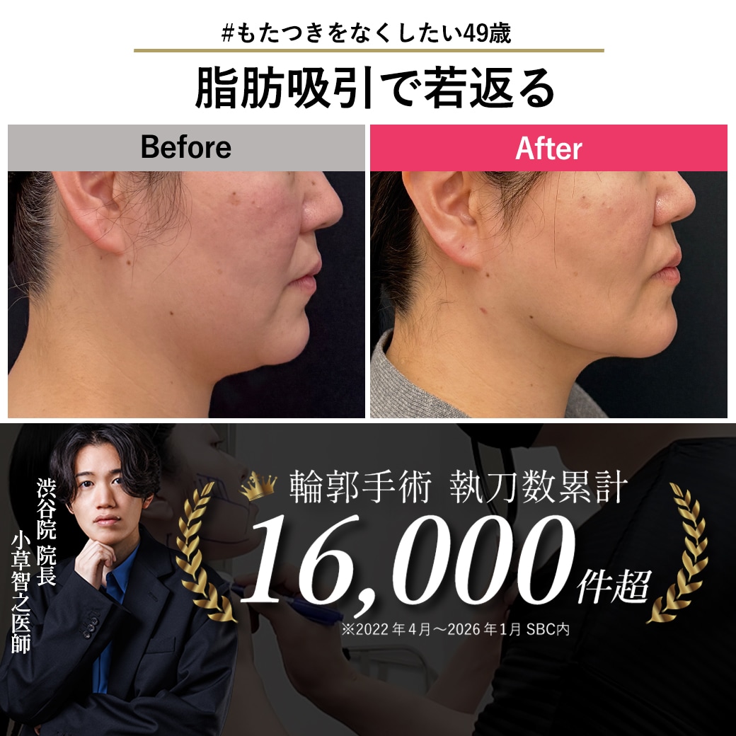 【脂肪吸引の名医】脂肪吸引でもたつきをなくして若返る【脂肪吸引が上手いおぐさ先生】