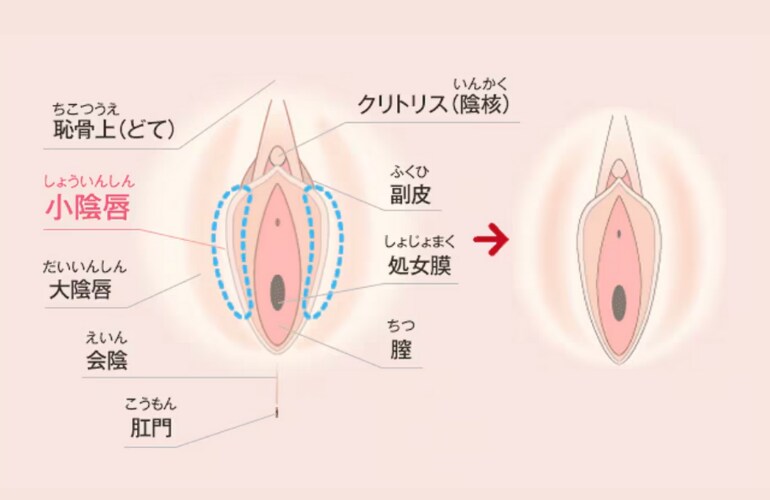 小陰唇縮小術