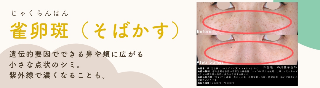 【雀卵斑＝そばかす】