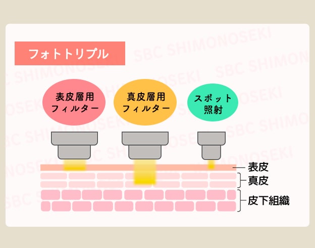 【フォトトリプル】ダブル照射＋スポット照射で濃いをシミ撃退！