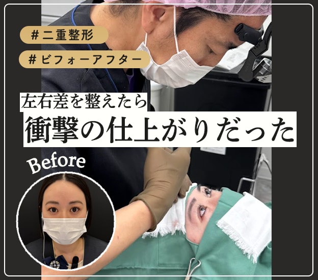 【衝撃変化!】二重整形のリアルをお届け!左右差を整えたら…スタッフが手術を受けました!