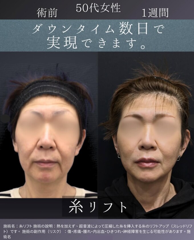 得意施術：輪郭の引き上げ・中顔面・ほうれい線のたるみ改善
