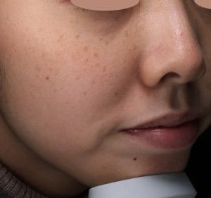 29,800円で顔中のシミを取りたい方は予約！
