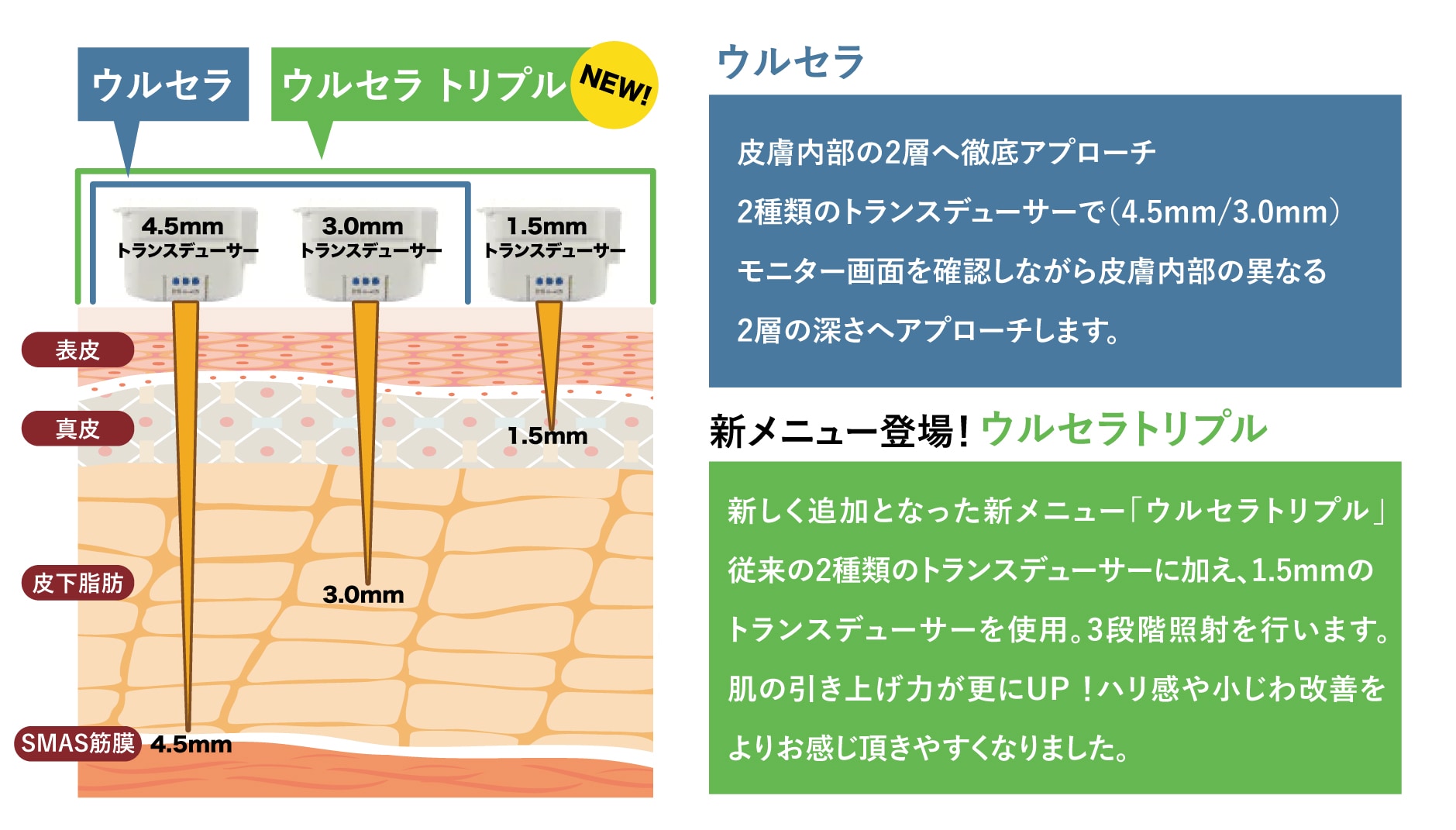 ウルセラとウルセラトリプル