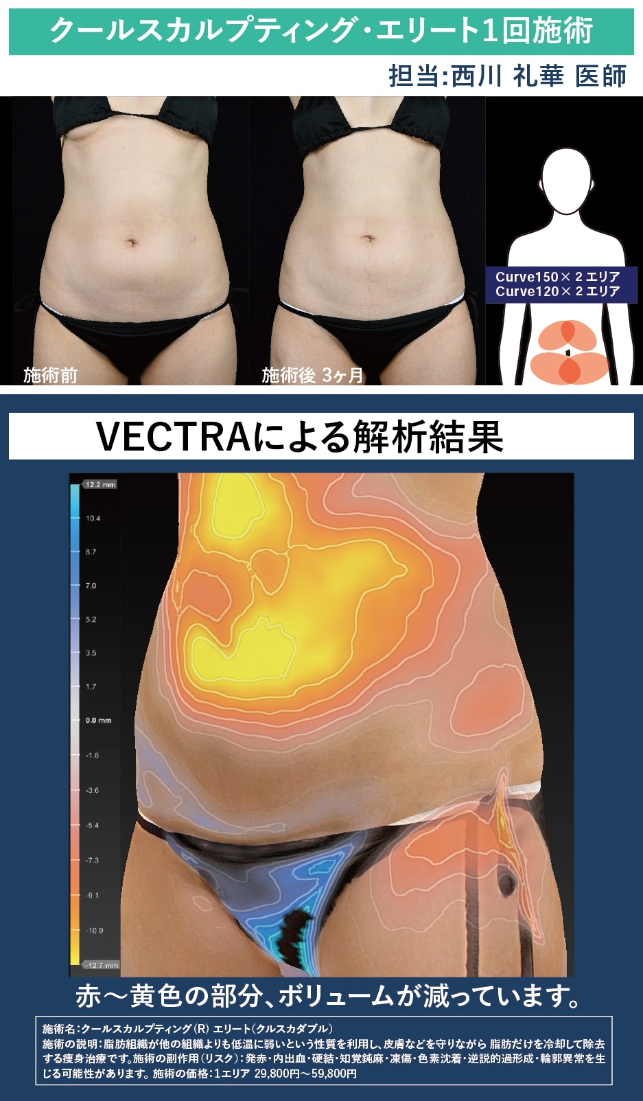 クールスカルプティング•エリート１回施術でどのくらいの効果がある？