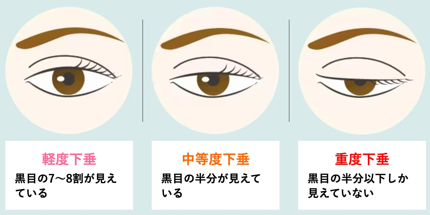 眼瞼下垂<br />
