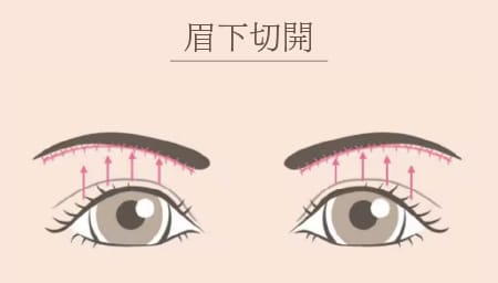 眉下切開（切る施術）