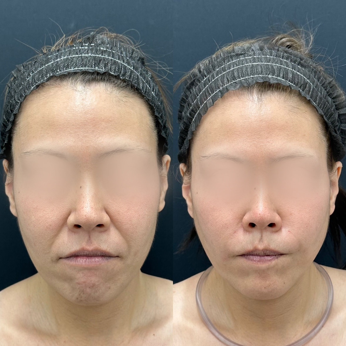 【38歳女性のお客様】糸リフト＋注入治療<br />
