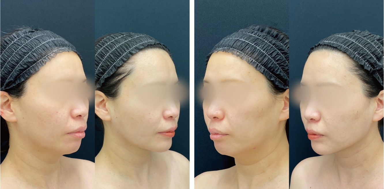 【40歳女性のお客様】脂肪吸引＋糸リフト＋注入治療