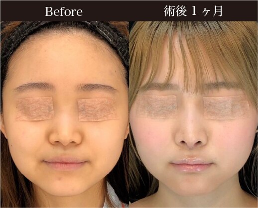 〈施術内容〉<br />
鼻中隔延長 肋軟骨 / 軟骨移植<br />
鼻柱下降術 / プロテーゼ / 鼻尖形成3D法