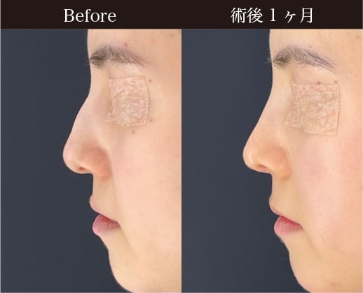 〈施術内容〉<br />
鼻尖形成3D法 / 軟骨移植<br />
鼻中隔延長 / 鼻骨骨切り / ハンプ切除 <br />
