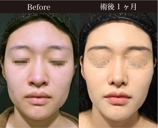 〈施術内容〉<br />
鼻尖形成3D法 / 鼻尖部軟骨移植<br />
鼻中隔延長 鼻中隔軟骨 <br />
内側法+締め付け縫合 